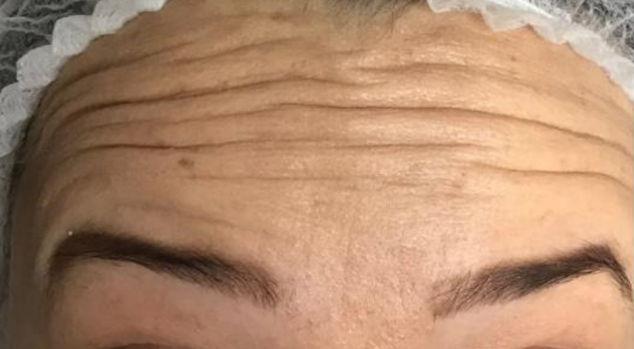 Botox - Facial Lines & Wrinkles